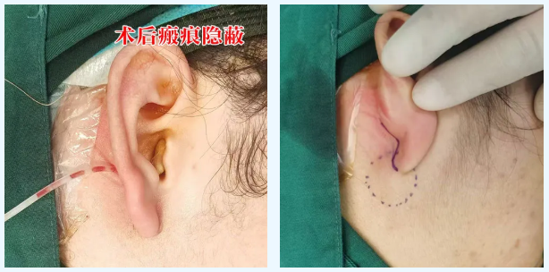 西安凤城医院耳鼻咽喉头颈外科腮腺肿瘤手术成功突破“隐藏切口+精准分离”