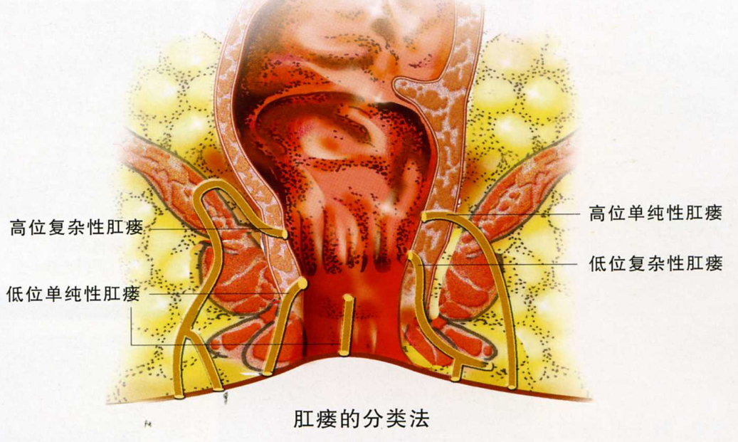 他一年前在家鄉的其它醫院確診為肛瘻,之後經過肛瘻手術康復.