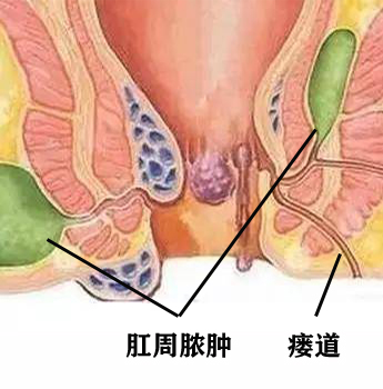 肛周脓肿.jpg