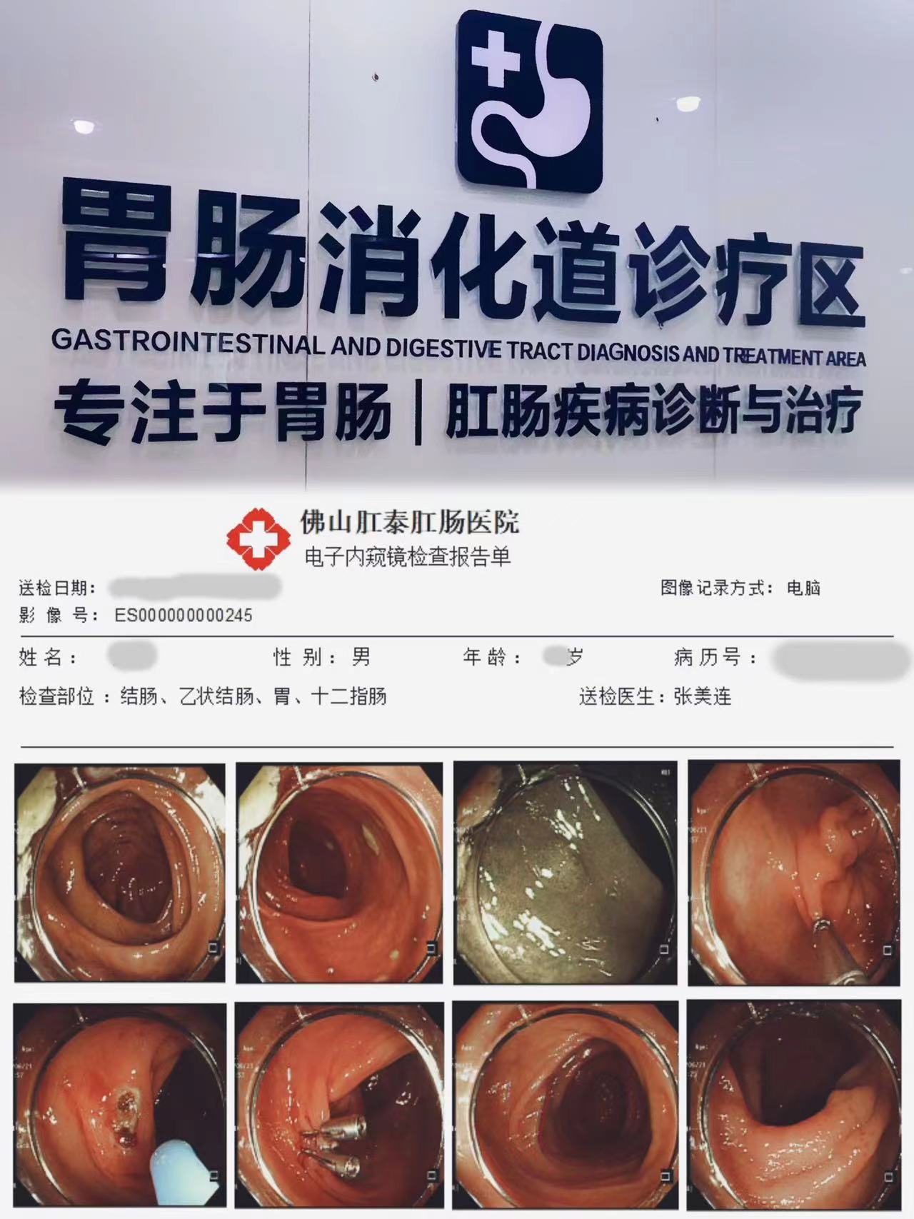 20230928101302107597.jpg 蔡先生45岁,主述反复便血,内镜发现横结肠距肛缘约16--7cm处见多枚广基粘膜隆起。予内镜下切除1个送检,无出血,余予APC灼除,创面结痂无出血,钛夹2枚夹闭创面。.jpg