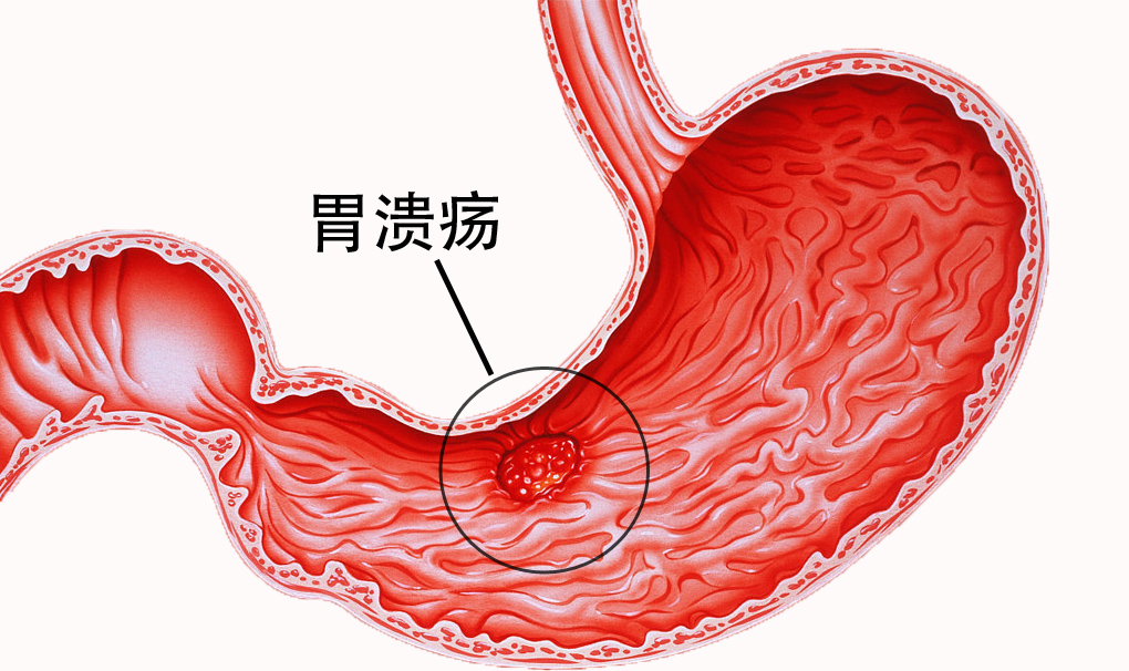 胃溃疡.jpg