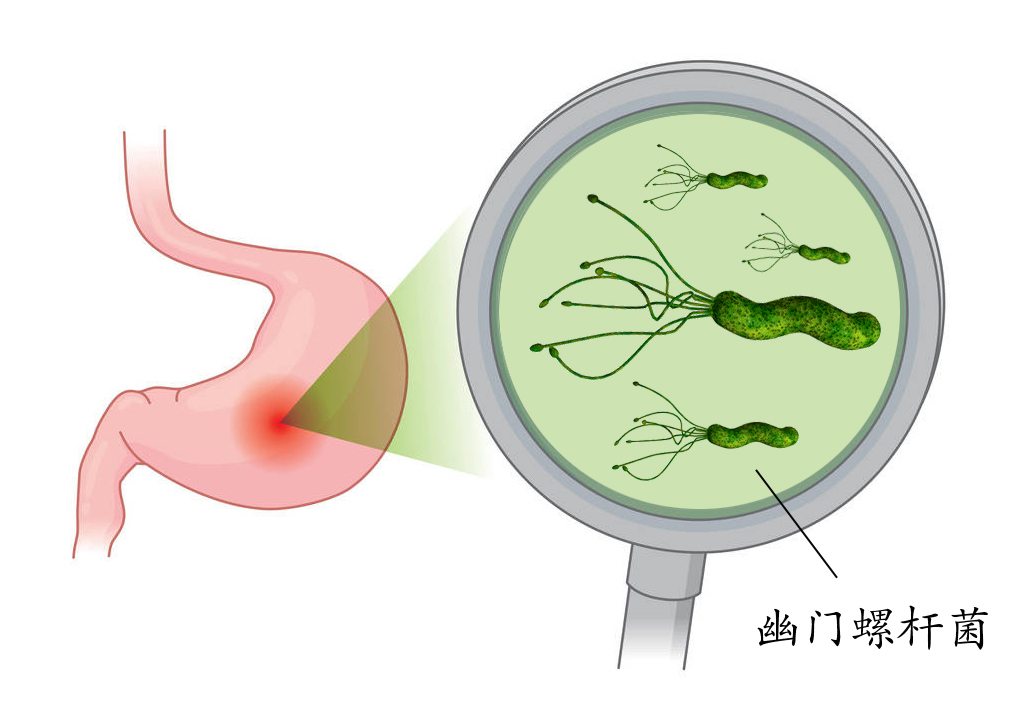 佛山肛泰医院：如何判断幽门螺杆菌是否根除？