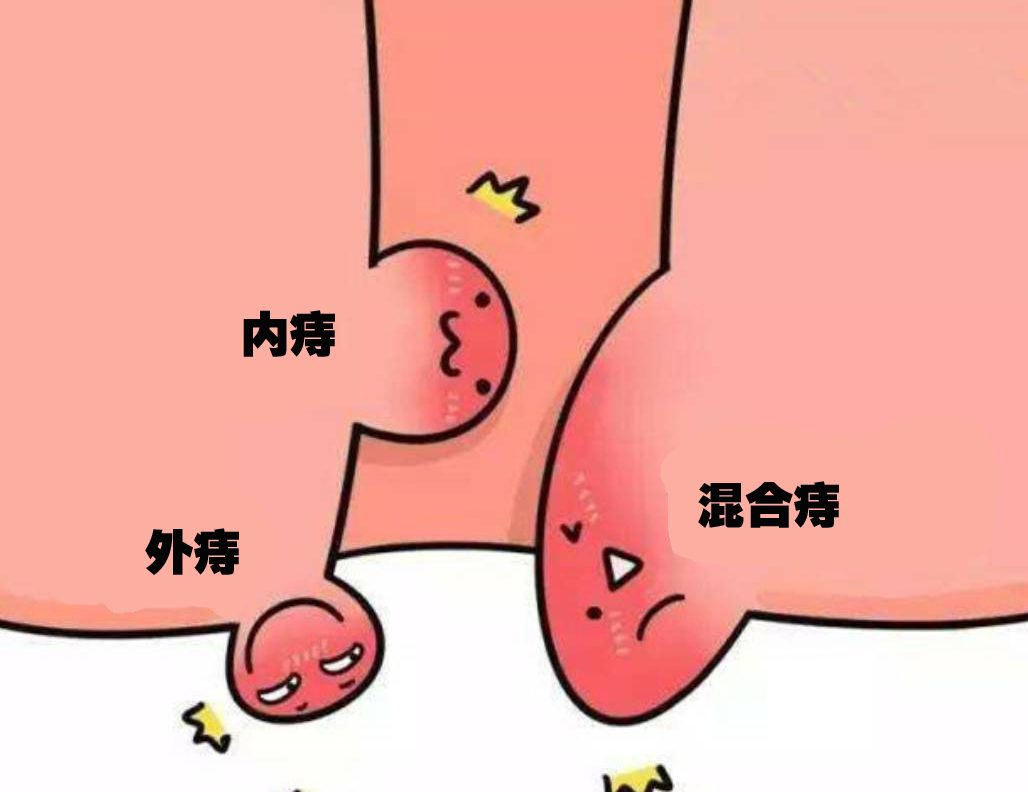 痔疮分型.jpg
