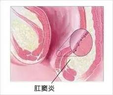 肛窦炎.webp