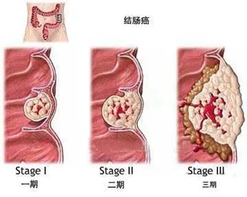 广东民安医院肠癌的6大高危因素与10个警戒信号