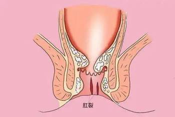 广东民安肛肠医院肛裂十个经常出现的问题让你更了解肛裂