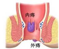 广州东大肛肠医院正规“出口”不适，都是痔病惹的？