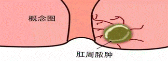 广州东大肛肠医院正规肛周肿痛可能不是痔疮，而是肛周脓肿！