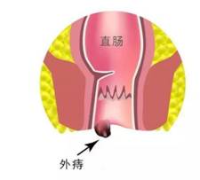 广州东大肛肠医院：怎么痔疮再临床上有哪些常见的表现呢？