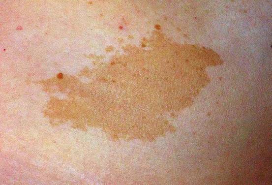 这个皮肤传染病，50%的人都会得，不幸❝中招❞怎么办？